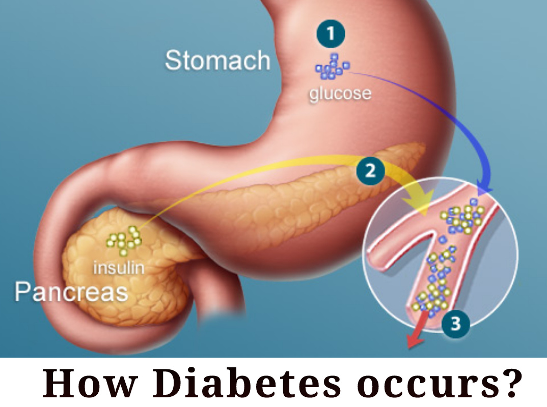 57_Ek insana la Diabetes kaiso hote?